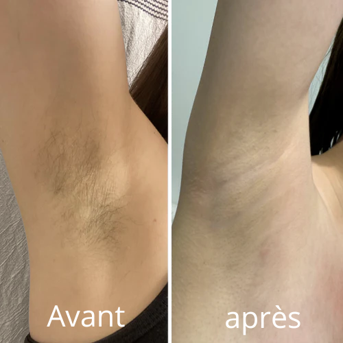 Résultat avant après utilisation de la crème dépilatoire Sonrao, peau lisse et nette